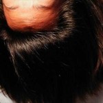 頭皮の皮脂が多いと抜け毛が増える？髪に与える悪い影響は！